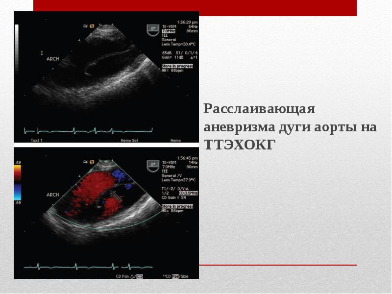 Аневризма брюшной аорты узи признаки и фото с описанием