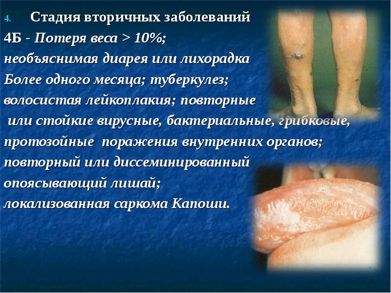 Стадия вторичных заболеваний Стадия вторичных заболеваний 4Б - Потеря веса >