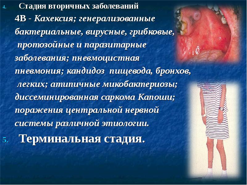 Стадия вторичных заболеваний Стадия вторичных заболеваний 4В - Кахексия; генерализованные 