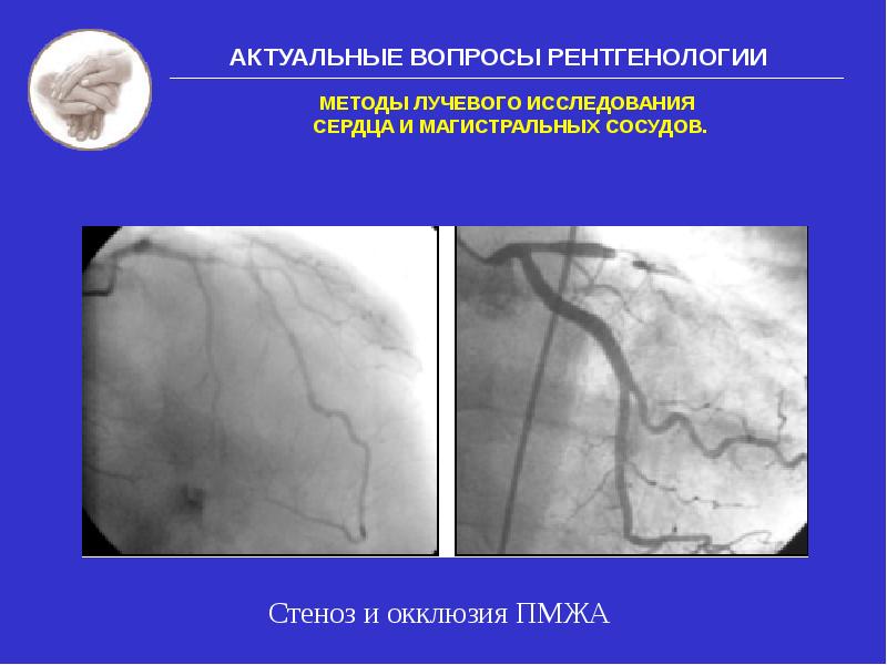 Методы лучевого исследования сердца и сосудов презентация
