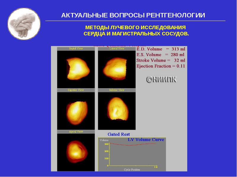 Лучевые исследования. Лучевые методы исследования сердца. Современные методы исследования сердца. Методы лучевого исследования сердца и сосудов. Лучевые методы исследования сосудов.