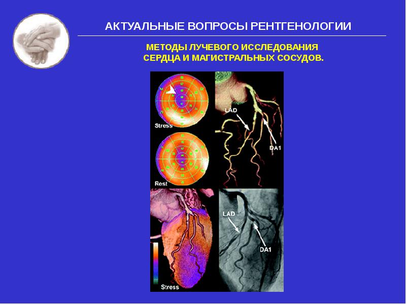 Методы лучевого исследования сердца и сосудов презентация