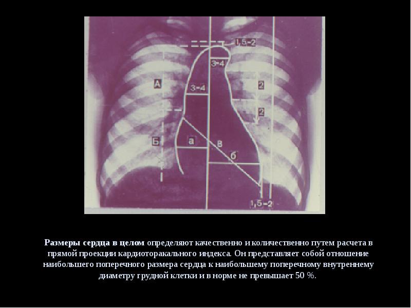 Размеры сердца. Поперечный размер сердца в прямой проекции представляет собой. Поперечный размер сердца. Определение размеров сердца.