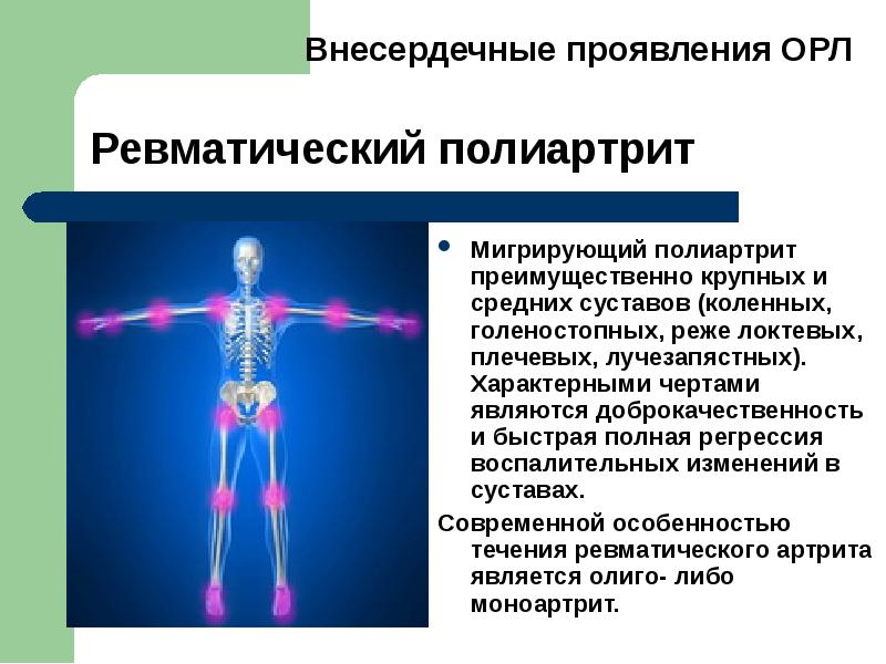 Острая ревматическая лихорадка картинки