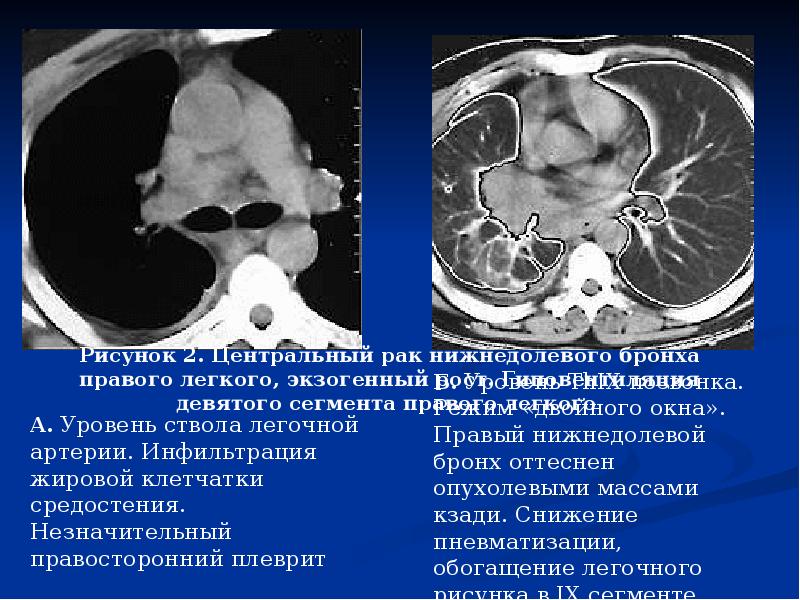 Клиническая картина рака 4 стадии