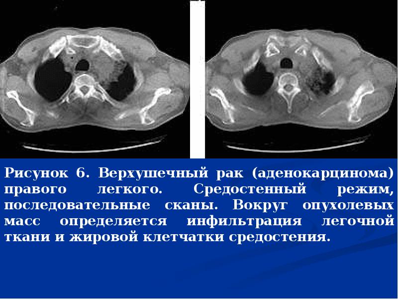 Рак легкого презентация онкология