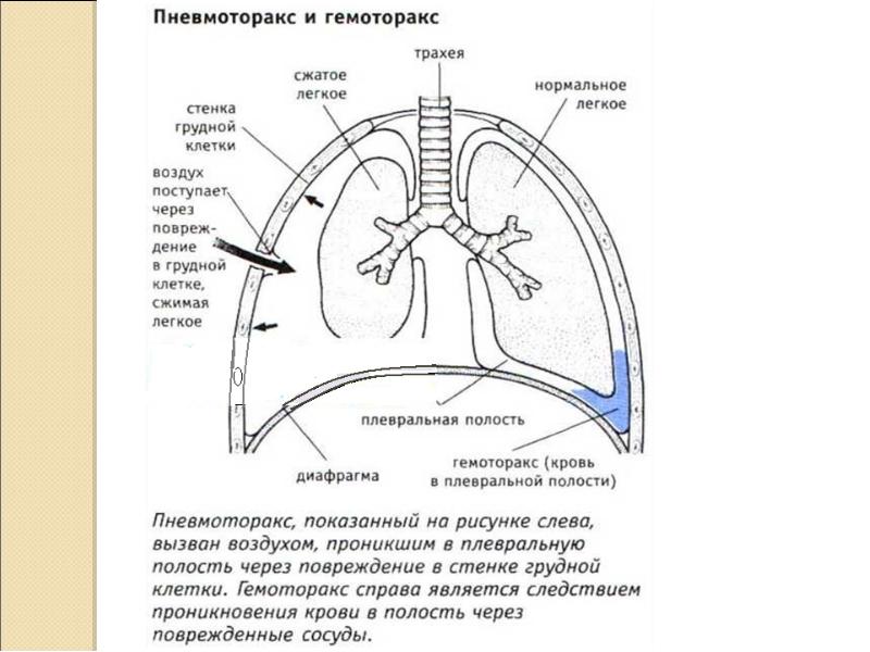 Пневмоторакс карта вызова