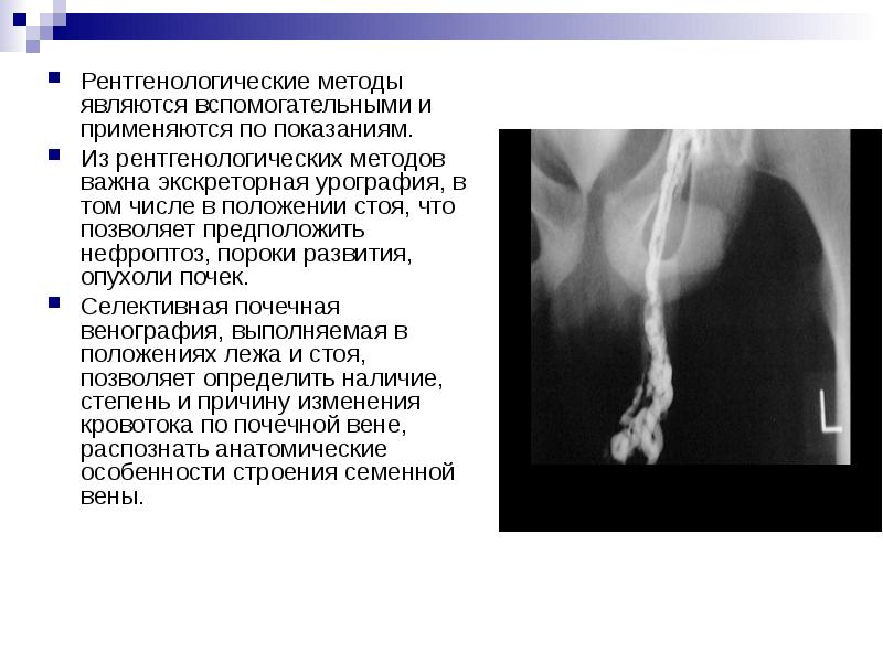 Варикоцеле у детей презентация