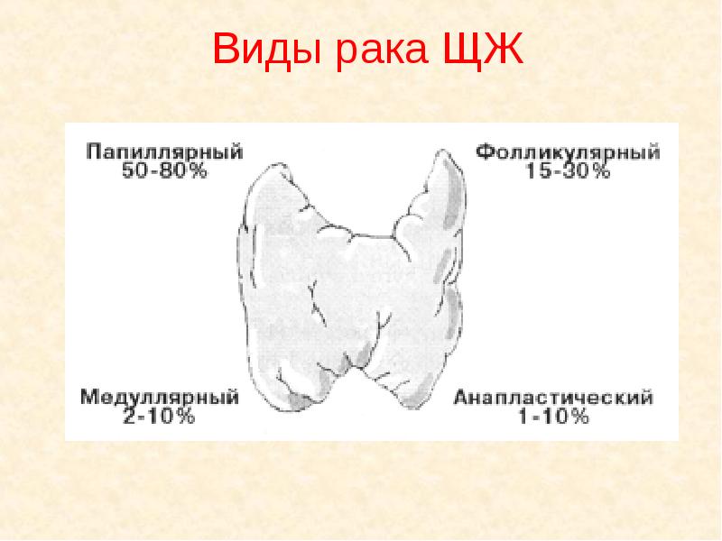 Злокачественные опухоли щитовидной железы презентация