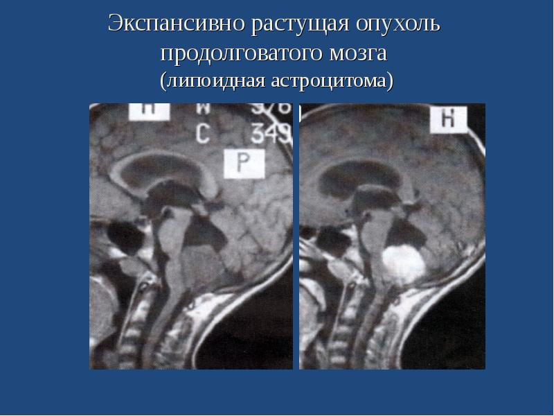 Опухоль мозга презентация