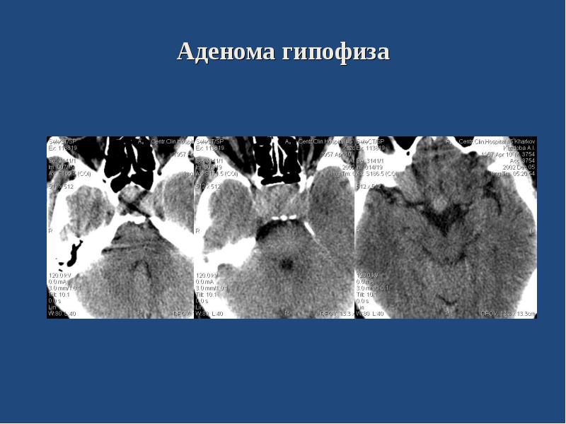 Опухоли головного мозга презентация неврология