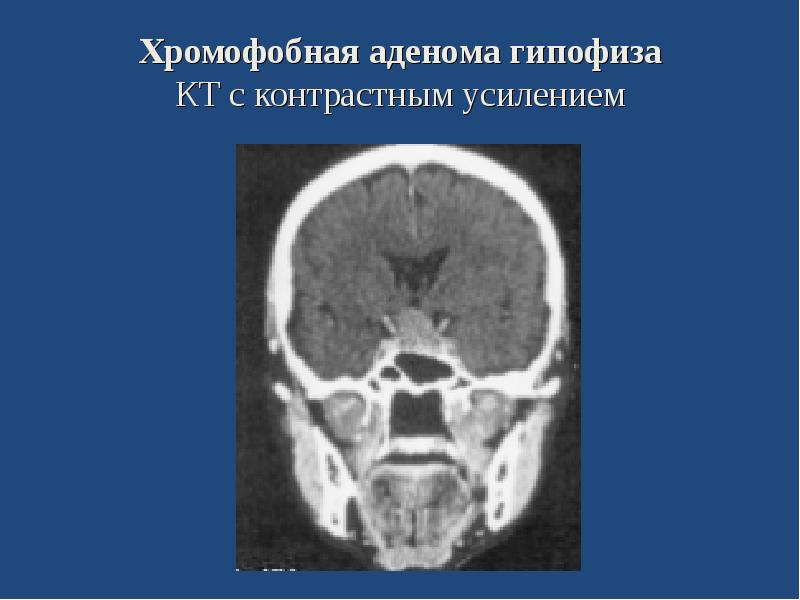 Сестринский уход при опухолях головного мозга презентация