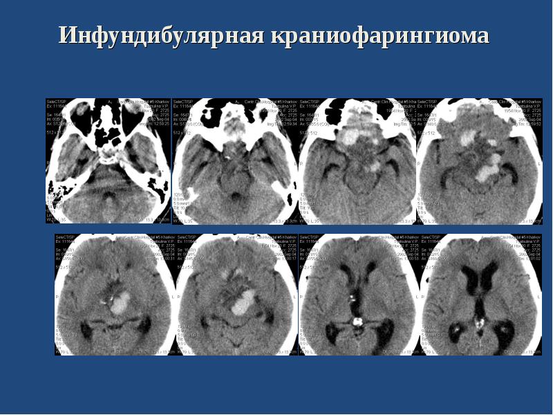 Опухоли головного мозга презентация неврология