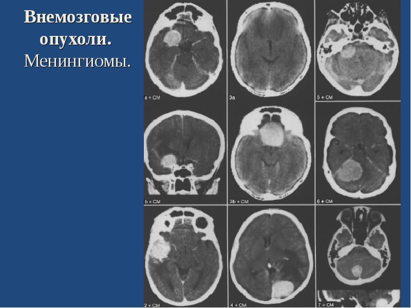 Опухоль головного мозга презентация