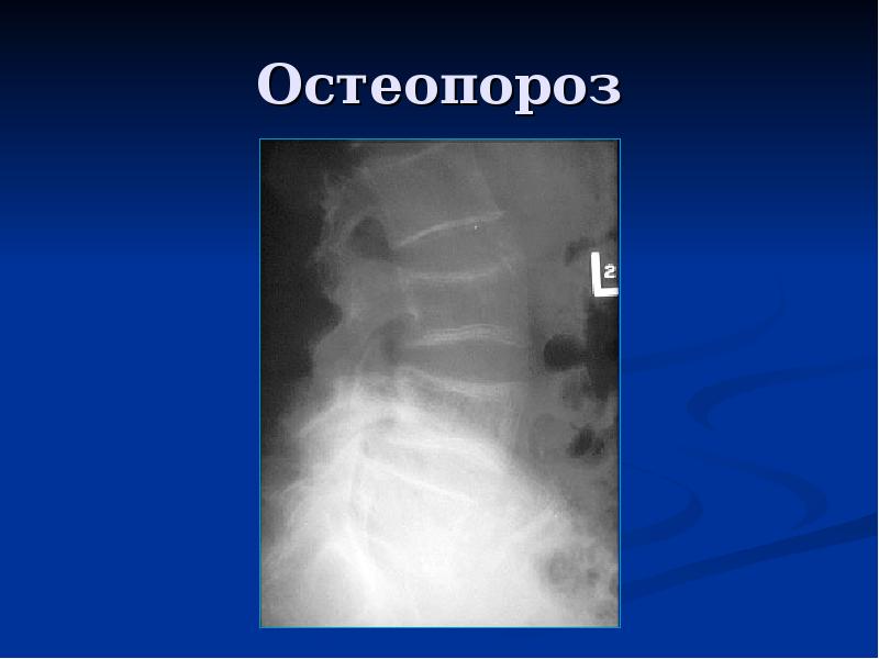 Остеопороз позвоночника. Остеопороз поясничного отдела позвоночника рентген. Остеопороз позвоночника рентгенограммы. Остеопороз позвонков рентген. Диффузный остеопороз позвоночника рентген.