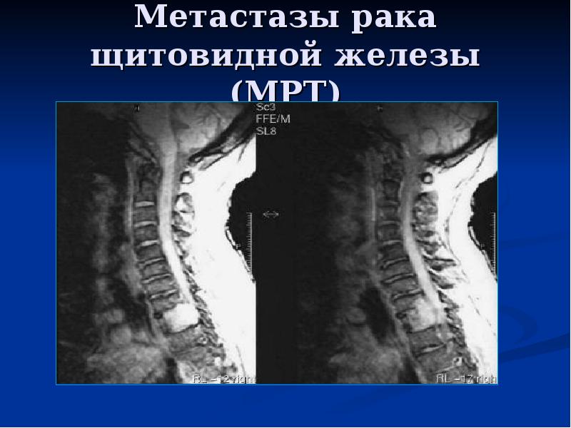 Лучевая диагностика позвоночник презентация