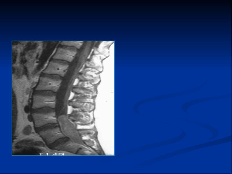 Кабель канал позвоночник. Относительный Сагиттальный стеноз позвоночного канала с5-с7. Рентгенодиагностика заболеваний позвоночника. Плазмоцитома позвоночника. Вторичный стеноз позвоночного канала.