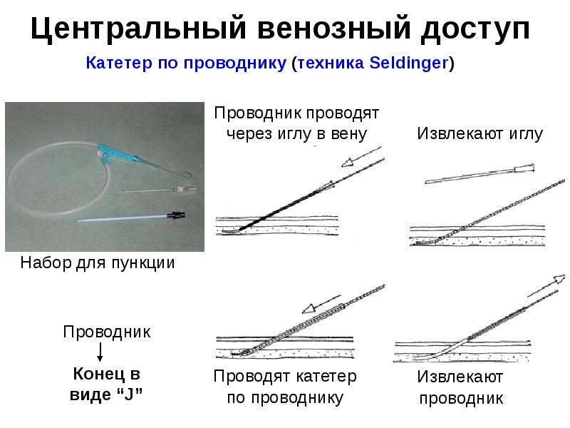 Измерение центрального венозного давления