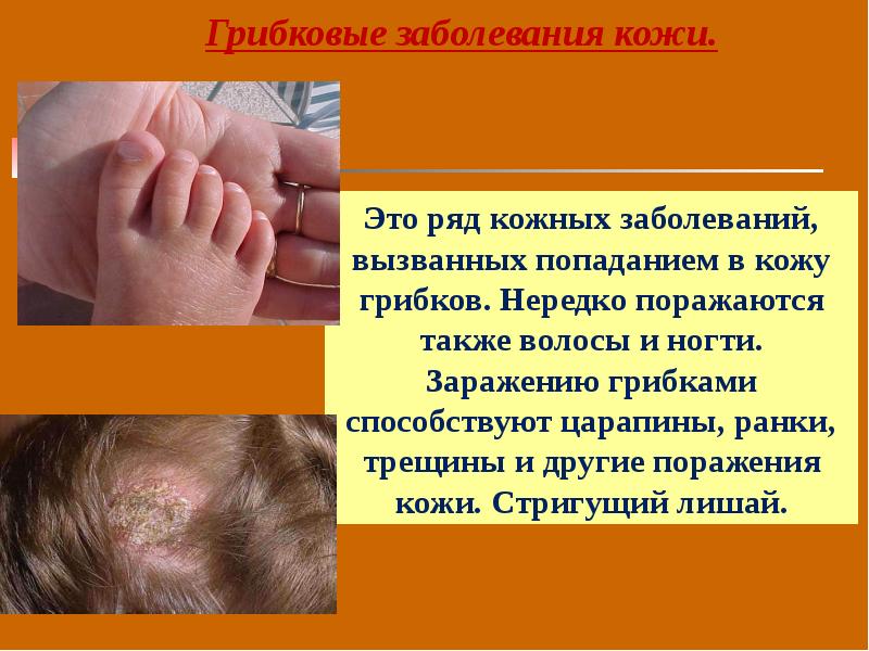 Уход за детьми с заболеваниями кожи презентация