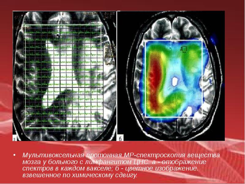 Лучевая диагностика нервной системы презентация