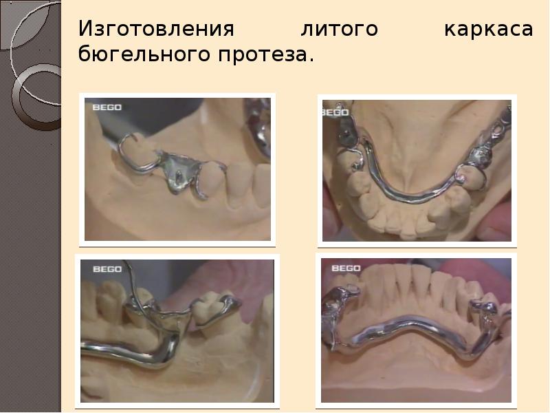 История болезни по стоматологии бюгельного протеза