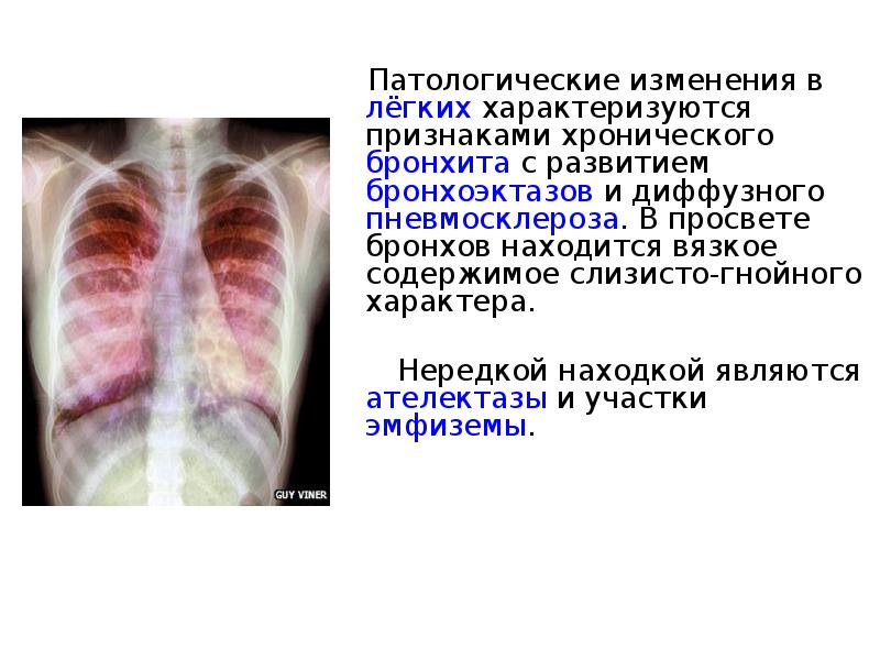 Диффузная легких. Диффузный пульмосклероз легких что это. Диффузный пневмофиброз бронхит. Посттуберкулезный пневмосклероз. Патологические изменения в легких.