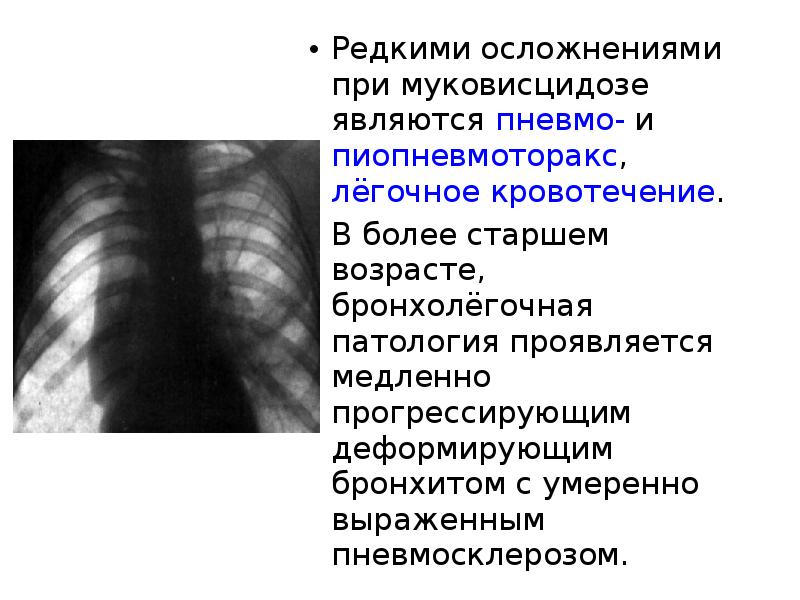 Муковисцидоз у детей презентация