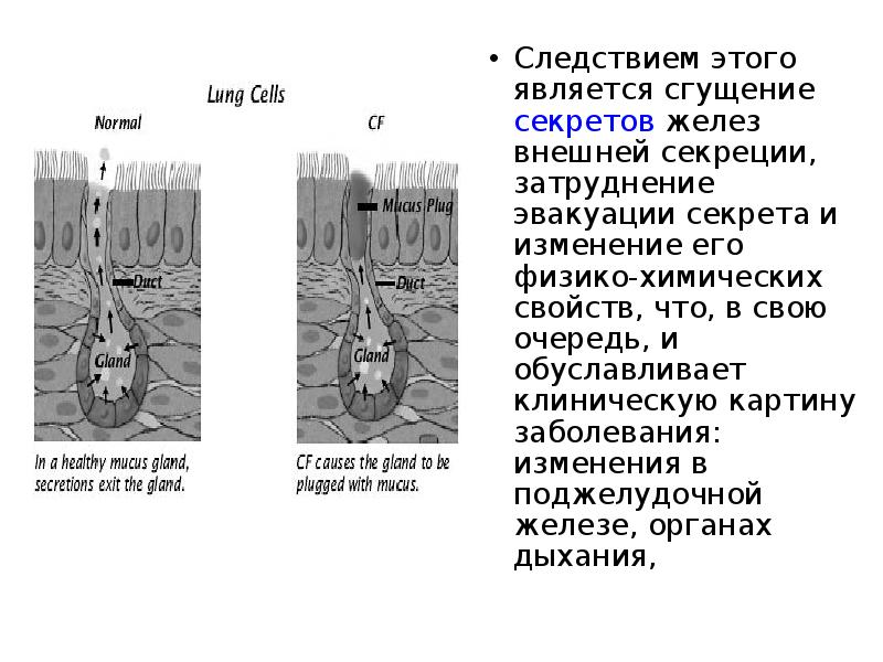 Мукоидоз дистрофия рисунок