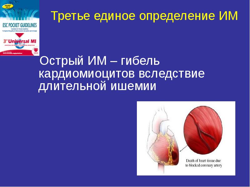 Болезни сердца презентация. Инфаркт миокарда презентация. Ишемическая болезнь сердца презентация.