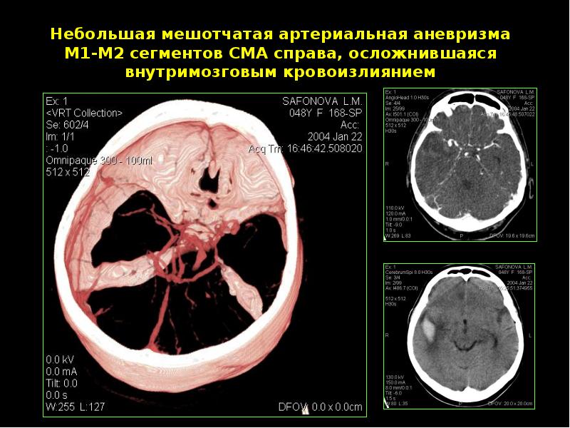 Мешотчатая аневризма. М2 сегмент СМА на кт. Аневризмы левой СМА ( сегмент м1). Мешотчатая аневризма средней мозговой артерии. Мешотчатая аневризма с7.