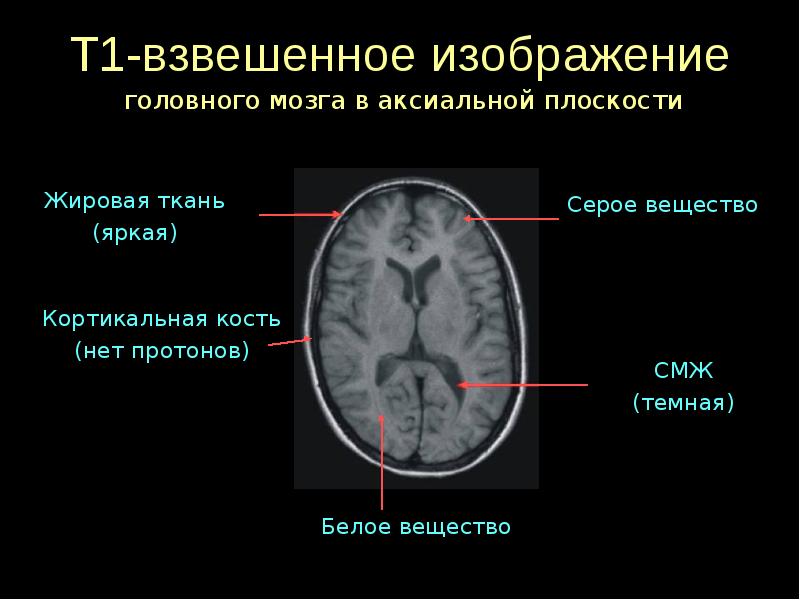 Т1 и т2 изображения мрт