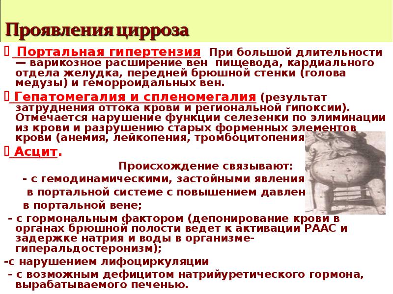 Тромбоцитопения при циррозе печени. Цирроз и портальная гипертензия. Варикозное расширение вен при портальной гипертензии. Цирроз печени варикозное расширение вен. Патогенез варикозного расширения вен при портальной гипертензии.