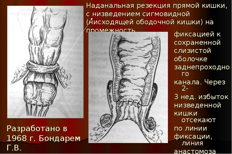 Операция На Прямой Кишке Фото