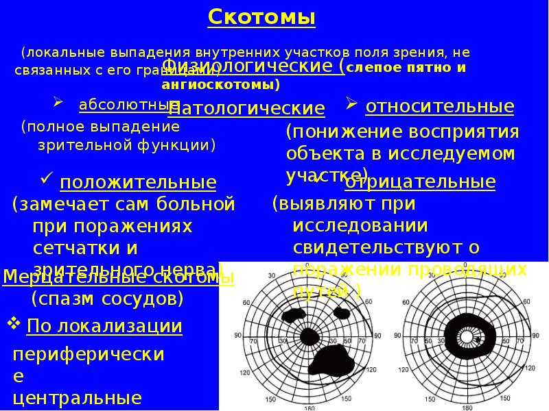 Выпадение поле зрения