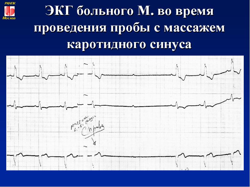 Синдром каротидного синуса