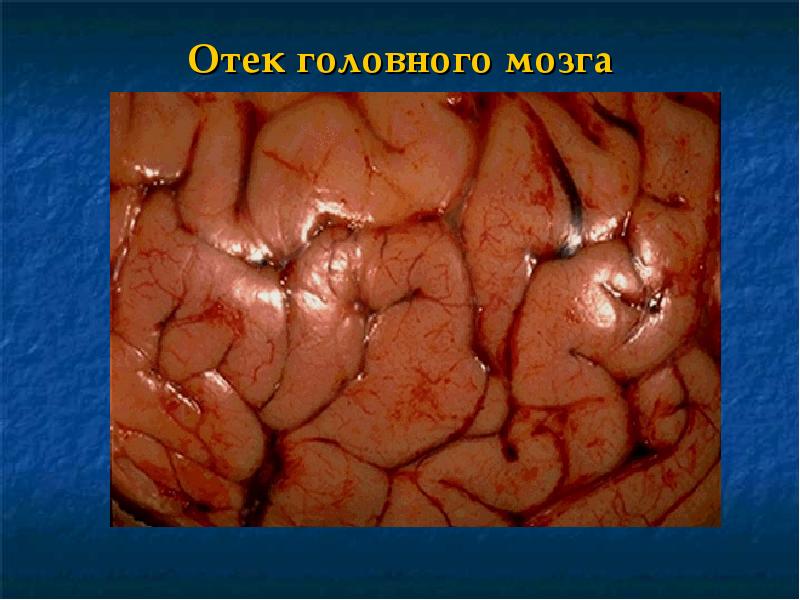 Презентации на тему отеки