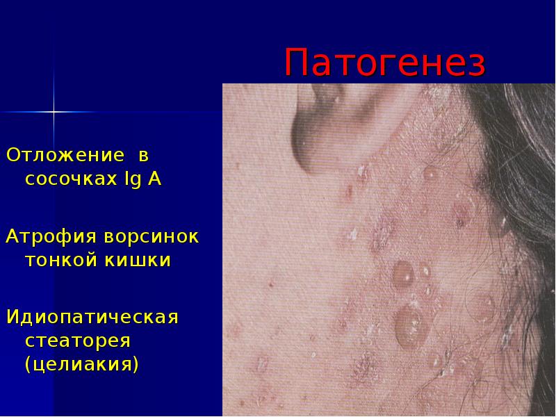 Пузырные дерматозы презентация