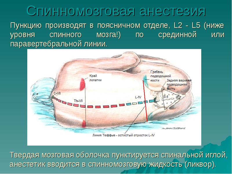 Эпидуральная анестезия презентация