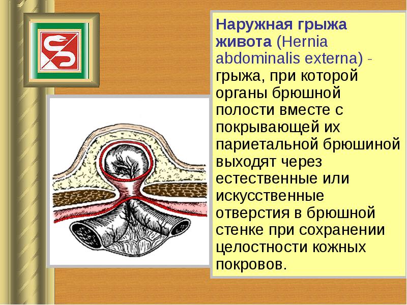 Грыжи передней брюшной стенки у детей презентация