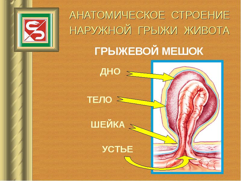 Грыжи передней брюшной стенки у детей презентация