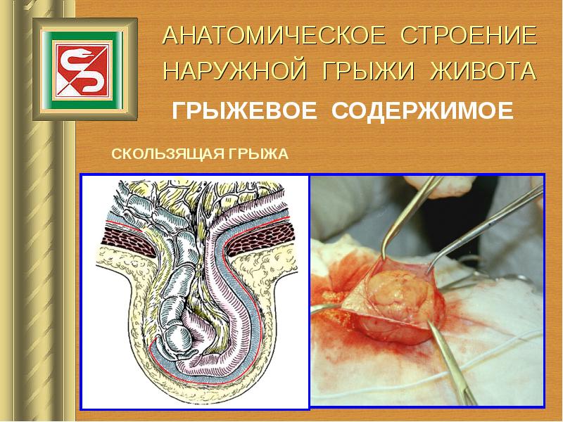 Грыжа передней брюшной стенки презентация