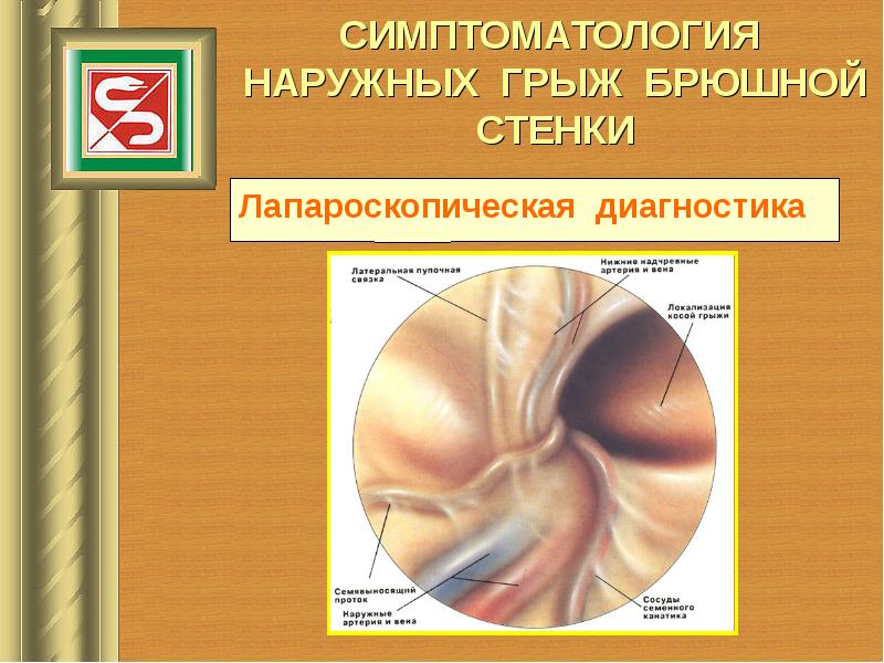 Грыжи передней брюшной стенки у детей презентация