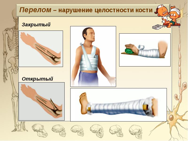 Перелом картинки для презентации