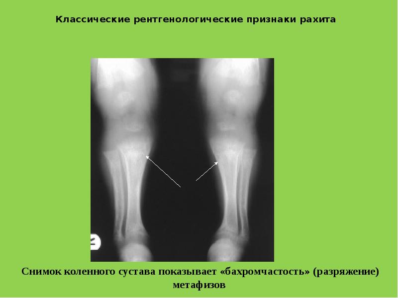 Рентгенологическая картина в период разгара рахита характеризуется