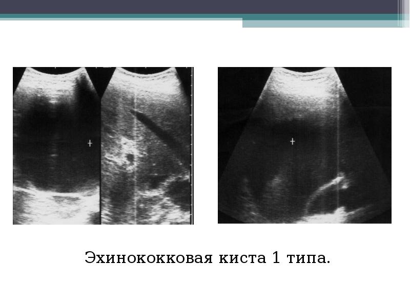 Эхинококковая киста печени в ультразвуковом изображении характеризуется