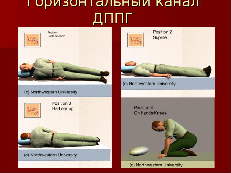 Пароксизмальное головокружение. ДППГ горизонтальный канал. Горизонтальное пароксизмальное головокружение. Упражнения для горизонтального канала ДППГ. ДППГ горизонтального канала маневр.