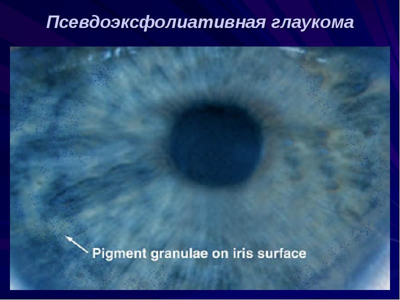 Презентация на тему вторичная глаукома