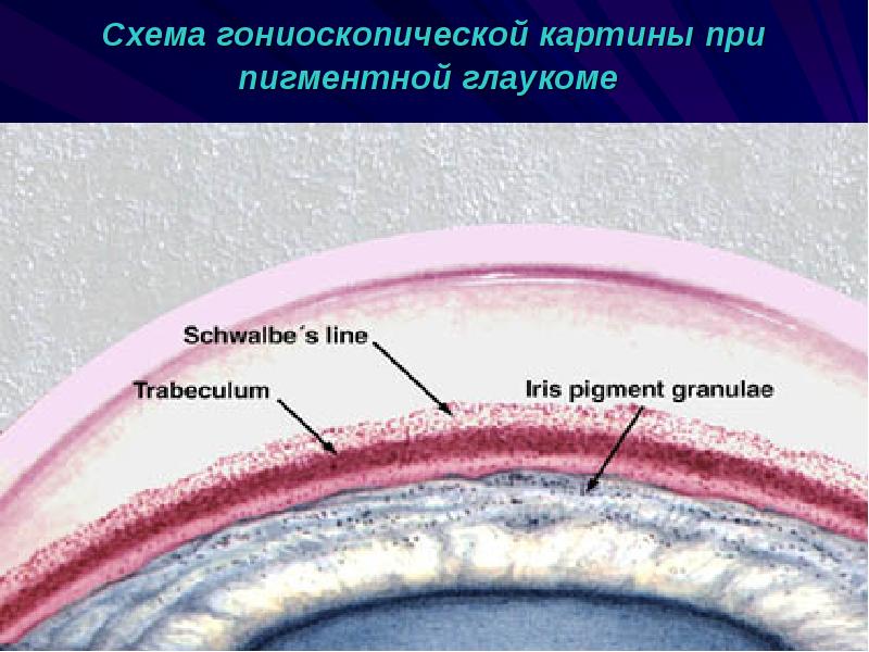 Презентация на тему вторичная глаукома