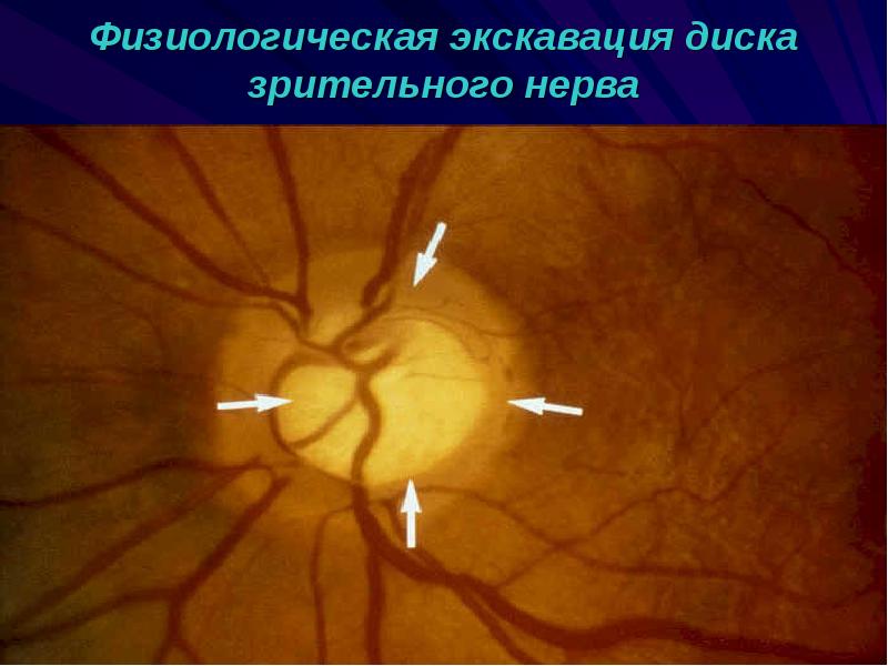 Темы для презентаций на тему глаукома