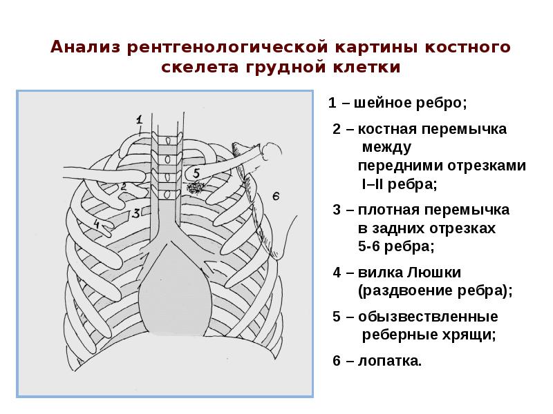 Отрезки ребер. Анализ рентгенологической картины костного скелета грудной клетки. Костная перемычка ребер. Костный каркас грудной клетки рентгенологически. Костные ориентиры грудной клетки.